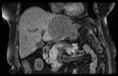 MR perfusion image study with motion compensation