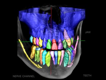 AI-assisted automation of dental applications