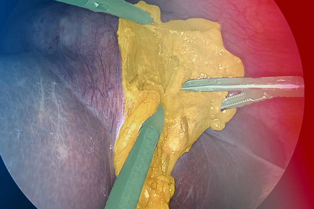 ImViA - Structure, analyze, and annotate surgical videos 