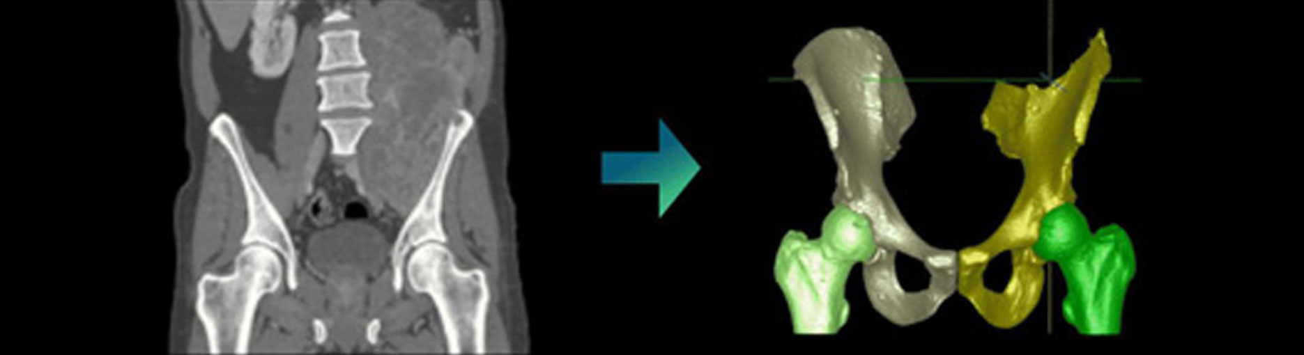 Hip and femur segmentation Hip and femur segmentation