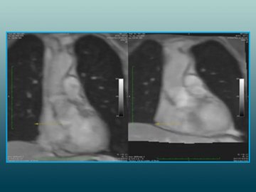 Compensation of Cardiac Motion